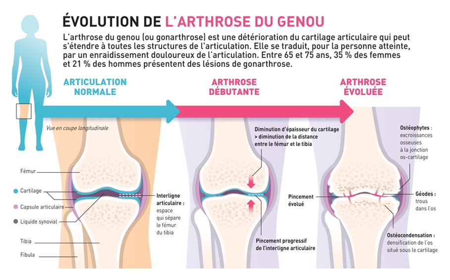 Arthose du genou : évolution